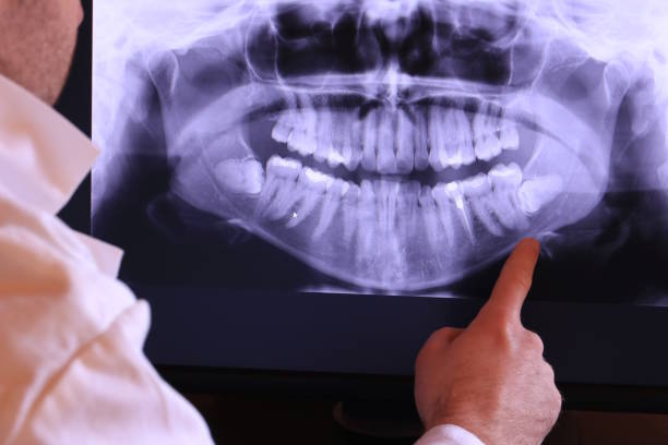 Best Emergency Tooth Extraction in Washington, GA